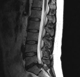 Options de diagnostic pour l'ostéochondrose lombaire