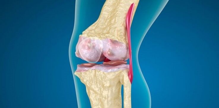 Dommages à l'articulation du genou par l'arthrose